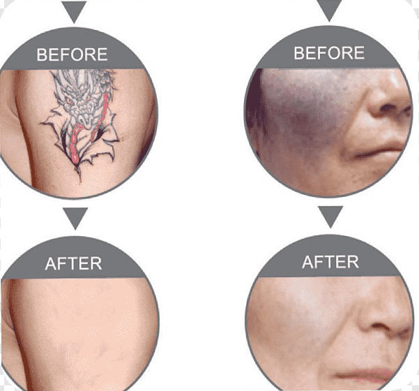 png-transparent-nd-yag-laser-tattoo-removal-rejuvenation-laser-hair-removal-others-tattoo-skin-whitening-hair-removal